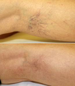 Sclerotherapy before and after pic