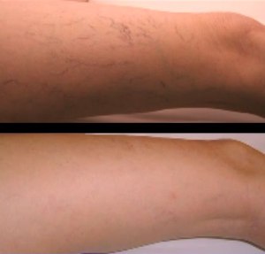 Sclerotherapy before and after pic