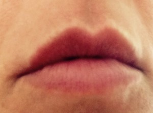 my lips after procedure