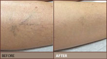 Sclerotherapy before and after pic