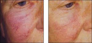 Veinwave before and after pic